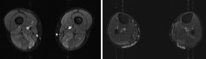 Imágenes de una RM. En la secuencia STIR se puede observar hiperintensidad de los músculos bíceps femoral, semimembranoso y gastrocnemios.