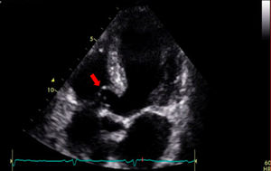 Imagen del ecocardiograma transtorácico que muestra el aneurisma del septo membranoso interventricular (flecha).
