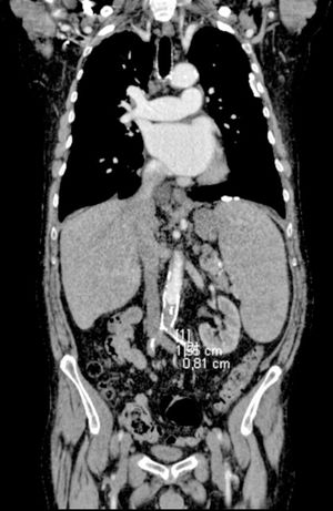 AngioTC aórtica. Oclusión de aorta abdominal y ambas iliacas.