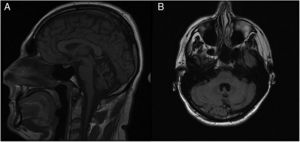 RM cerebral del paciente en la que se observa atrofia de vermis cerebeloso. A) Corte sagital en secuencias T1. B) Corte axial en secuencias FLAIR.