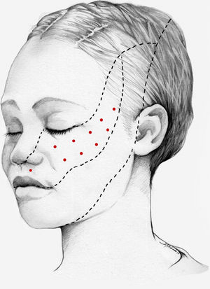 Esquema de infiltración en territorio V2 en pacientes con neuralgia del trigémino. El mapa de infiltración se puede ampliar a puntos gatillo de la cavidad oral. Se debe valorar la posibilidad de infiltrar algunos puntos de la hemifacies contralateral para reducir la probabilidad de asimetría facial.