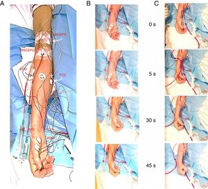Estudio neurofisiológico. A) Localización de los electrodos en los músculos bíceps, tríceps, extensor común de los dedos, flexor común de los dedos, musculatura de eminencia tenar y abductor del quinto dedo del miembro superior derecho mediante electrodos adhesivos de contacto. B) Evolución de las manifestaciones clínicas durante la prueba de inducción. C) Evolución de la clínica durante el inicio de la hemodiálisis. Los números centrales indican el tiempo (en segundos) desde el inicio en ambos casos.