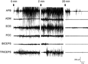 EMG durante la hemodiálisis. El registro EMG mostró en todo momento un patrón irregular y discontinuo de la actividad muscular. Los números indican el tiempo. ADM: abductor digiti minimi; APB: abductor pollicis brevis; ECD: extensor común de los dedos; FCC: flexor común del carpo.