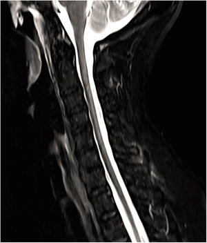 Corte sagital y medio de resonancia magnética cervical potenciada en T2 que muestra lesión hiperintensa que afecta cordones posteriores desde C2 hasta T1.