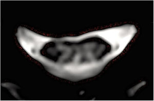 Corte axial de resonancia magnética potenciada en T2 que muestra lesión hiperintensa que compromete cordones posteriores a nivel cervical.
