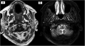 A) Imagen hipointensa en T1 en agujero yugular derecho. B) Imagen heterogénea en T2 en agujero yugular derecho, con imágenes tubulares con vacío de señal en el interior.