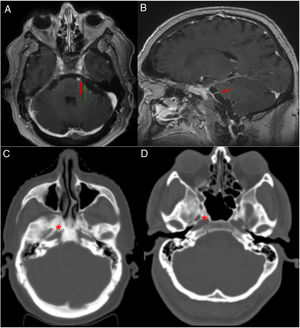 A y B) Resonancia magnética cerebral. Secuencia T1 con contraste: A) corte axial, B) corte sagital. Flecha roja: nervio abducens izquierdo, emergiendo desde la cisterna prepontina, hipercaptante probablemente por afectación en el conducto de Dorello. Flecha verde: nervio trigémino, sin captación de contraste. C y D) TC craneal con ventana hueso. Corte axial: C) se observa aumento difuso de la densidad ósea a nivel del clivus y esfenoides (asterisco rojo) sugestivo de infiltración ósea metastásica, D) imagen de paciente control, sin aumento de la densidad ósea en base de cráneo.