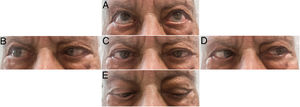 A) Supraversión normal. B) Versión a la derecha con abducción parcial del ojo derecho. C) Mirada centrada, con endotropia bilateral. D) Versión a la izquierda con leve déficit de abducción del ojo izquierdo. E) Infraversión; se observa tendencia a endotropia del ojo derecho. Convergencia conservada no presente en la figura. Exploración registrada a los 14 días de tratamiento, con mejoría parcial, principalmente del nervio abducens izquierdo que es el hipercaptante en la RM cerebral. Persistía diplopía.