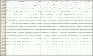 EEG de control tras suspensión de VPA. Sistema 10/20, montaje longitudinal. Actividad de fondo a 7-9Hz, sin detectarse grafoelementos agudos.