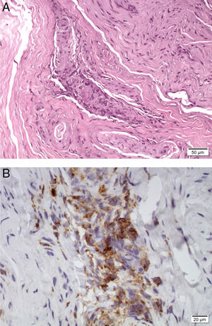 Biopsia de nervio sural. A) Hematoxilina-eosina. Arteria epineural con infiltrado inflamatorio y destrucción de la pared arterial. B) Inmunohistoquímica con anticuerpo frente a CD45. Las células inflamatorias en la arteria epineural muestran positividad frente a CD45.