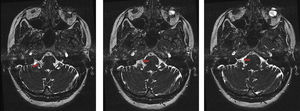 RM cerebral (3T): cruce neurovascular entre el nervio glosofaríngeo derecho y la arteria cerebelosa anteroinferior.