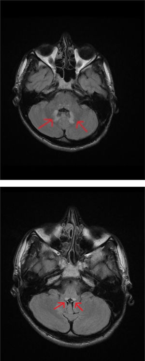 Resonancia magnética craneal. A y B) Pequeñas lesiones en la porción posterior del bulbo raquídeo y núcleos dentados con distribución simétrica en T2.