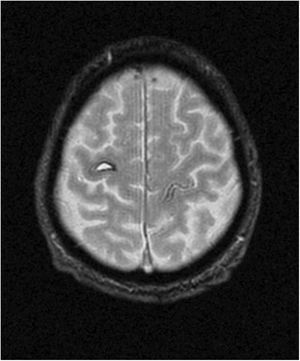RM cerebral en secuencia T2 (corte axial) que muestra una lesión hiperintensa en forma de semiluna con halo de hemosiderina en giro precentral derecho, compatible con hematoma intraparenquimatoso.