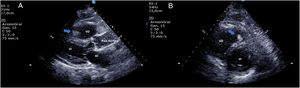 Ecocardioscopia. A) Eje paraesternal largo. Se identifican la aurícula izquierda (AI), el ventrículo izquierdo (VI), la raíz aórtica y el ventrículo derecho (VD) con una imagen hiperecogénica y móvil en su interior, compatible con trombo intracavitario en tránsito. B) Eje paraesternal corto en el que se observan ambos ventrículos, el VI a nivel de la válvula mitral. El VD se encuentra discretamente dilatado y con una masa hiperecogénica en su interior, compatible con trombo.