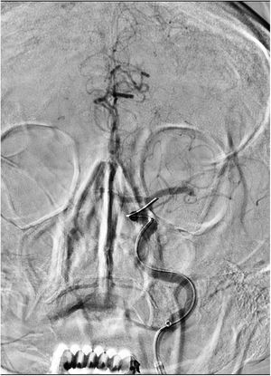 Oclusión de M1 distal izquierda; arteriografía realizada desde la carótida interna izquierda con GDB sin diluir.