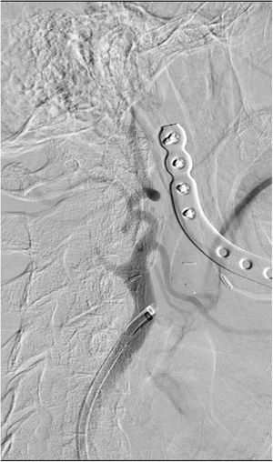 Oclusión de la carótida interna cervical derecha; arteriografía realizada desde la carótida común derecha con una dilución 50:50 de GDB y suero fisiológico.