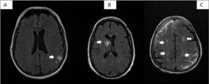 Algunas lesiones vasculares de la serie. A)Paciente8: dos pequeños hematomas cortico-subcorticales parietales izquierdos en la convexidad. B)Paciente1: hematoma agudo en núcleo caudado derecho abierto a sistema ventricular. C)Paciente26: lesiones hiperintensas isquémicas subagudas parietales bilaterales en áreas de vascularización limítrofe entre arterias cerebrales media y cerebrales anteriores.