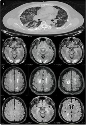 A) Tomografía de tórax en corte axial. Muestra múltiples imágenes en vidrio despulido en ambos pulmones. B) RM en corte axial, que muestra imágenes hiperintensas subcorticales y de la sustancia blanca en lóbulos occipitales. C) RM en corte axial en secuencia T2-FLAIR, con imágenes hiperintensas de la sustancia blanca de forma bilateral en lóbulos frontales. D) Control de RM 15 días después, donde se observa desaparición de las lesiones hiperintensas en lóbulos frontales y occipitales.