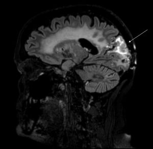 Secuencia T2 de RM de cráneo, corte sagital. Engrosamiento e hiperintensidad cortical con edema subcortical y realce de tipo gira.
