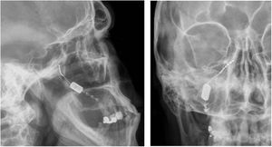 Radiografías, perfil y posteroanterior, mostrando un dispositivo de neuroestimulación inalámbrico implantado en la fosa pterigopalatina en un paciente con cefalea en racimos crónica refractaria ipsilateral (cortesía del Dr. José Miguel Láinez, Hospital Clínico Universitario, Valencia).