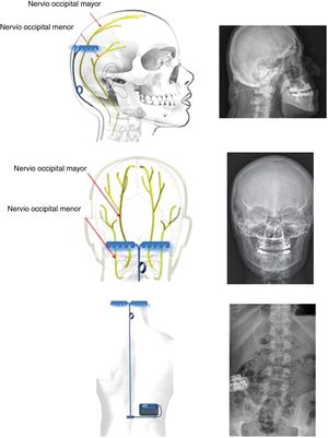 Esquemas y radiografías mostrando la implantación bilateral de electrodos a nivel extracraneal del hueso occipital y cableado subcutáneo que lo conecta al generador implantado subcutáneamente en la fosa lumbar derecha de un paciente con cefalea en racimos crónica refractaria.