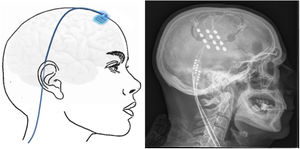 Esquema mostrando electrodos implantados en el área cortical motora a través de un orificio de trepanación frontal y cableado subcutáneo. A la derecha, radiografía craneal postcirugía que muestra los electrodos implantados en el córtex motor en un paciente con neuralgia del trigémino contralateral refractaria secundaria a esclerosis múltiple.