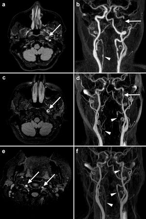 Características radiológicas evolutivas en diferentes secuencias de RM cerebral de la disección de las arterias cervicales. El estudio inicial (a, b) muestra una hiperseñal (flecha) del trombo intramural en el segmento cervical distal de la arteria carótida interna izquierda (a: FLAIR) y un defecto de llenado (flecha) (b: secuencias angiográficas) compatibles con una disección. Una irregularidad en la arteria vertebral derecha (punta de flecha) pasó inicialmente desapercibida en este estudio. Un mes después (c, d, e), una hiperseñal (flecha) con el signo de la luna creciente continúa estando presente en la arteria carótida interna izquierda (c: FLAIR), aunque se observa una mejoría en el flujo (flecha) (d: secuencias angiográficas). En este momento, la RM muestra también un aumento de señal (flechas) en el segmento extracraneal de ambas arterias vertebrales (e: FLAIR), lo cual se correlaciona con la ausencia de flujo (punta de flecha) (d: secuencias angiográficas), sugestivo de disección bilateral de las arterias vertebrales. Las secuencias angiográficas realizadas a los seis meses del inicio (f) muestran el restablecimiento del flujo en la arteria carótida interna izquierda y las arterias vertebrales (puntas de flecha).