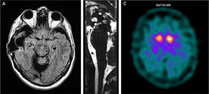 A) Resonancia magnética cerebral, secuencia FLAIR, corte axial, donde se aprecia una extensa encefalomalacia temporal derecha, asociada a una craniectomía (relacionado con la meningitis tuberculosa de la infancia) junto con dilataciones perivasculares en hipocampo, región caudal del estriado y mesencefálica bilateral. B) Resonancia magnética cerebral, secuencia T23D (CISS), corte sagital, donde se aprecian imágenes quísticas en el IV ventrículo y dilataciones perivasculares en el mesencéfalo. C) SPECT con I-123 ioflupano (DAT-scan) muestra una diminución de captación del radiotrazador en putamen bilateralmente.