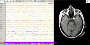 Pruebas complementarias (paciente número 16). 1A) Electroencefalografía de vigilia, que muestra un enlentecimiento difuso de la actividad bioeléctrica cerebral. 1B) Resonancia magnética craneal (RMN) secuencia FLAIR, que muestra una hiperintensidad focal de sustancia blanca en lóbulo temporal izquierdo.