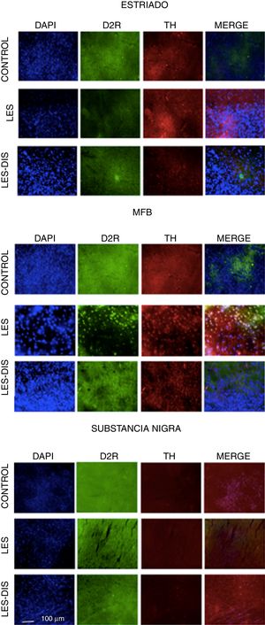 Inmunofluorescencia de triple marcaje para DAPI, TH y receptor dopaminérgico D2 en a) estriado, b) MFB y c) substancia nigra en los grupos tratados. Se puede evidenciar la mayor densidad celular en el estriado y MFB. Las flechas blancas indican la reactividad a los tres marcajes (DAPI+, TH+ D2+). Las fotos fueron tomadas a una escala de 1:100μm. Fuente: autor.