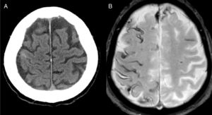 Paciente de 80 años con AAC. A) Imagen de TAC craneal que muestra una hiperintensidad en un surco de la convexidad frontal derecha. B) Imagen de RM en secuencia ecogradiente con presencia de siderosis superficial extensa y bilateral.