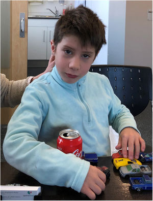Fenotipo del paciente a la edad de 7 años. Frente amplia, pabellones auriculares de implantación baja, amplios y rotados posteriormente (se objetiva el derecho en la foto), leve hipotelorismo, epicanto bilateral de predominio izquierdo, nariz bulbosa con narinas pequeñas, filtro liso, labio superior fino e inferior grueso y boca grande.