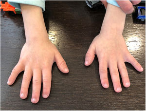 Manos pequeñas con braquidactilia (sobre todo falanges distales) y clinodactilia.