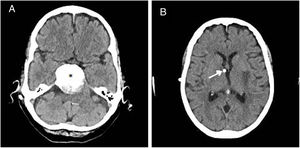 A) TC craneal en la que se objetiva el meningioma petroclival (asterisco) condicionante de la hidrocefalia compresiva que obligó a la implantación de una derivación ventricular. B) TC craneal que evidencia el extremo proximal de DVA situado en el ventrículo lateral derecho.