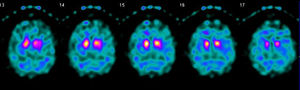 SPECT cerebral: disminución bilateral de los transportadores presinápticos de dopamina en el estriado.
