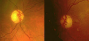 Funduscopia de ambos ojos, observándose palidez de predominio temporal.