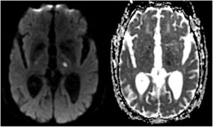 RM cerebral de nuestro paciente donde se puede apreciar una restricción en la difusión (a la izquierda, secuencia DWI) con hipointensidad correspondiente (a la derecha, secuencia ADC) en la localización que se presume para el núcleo dorsomedial del tálamo.