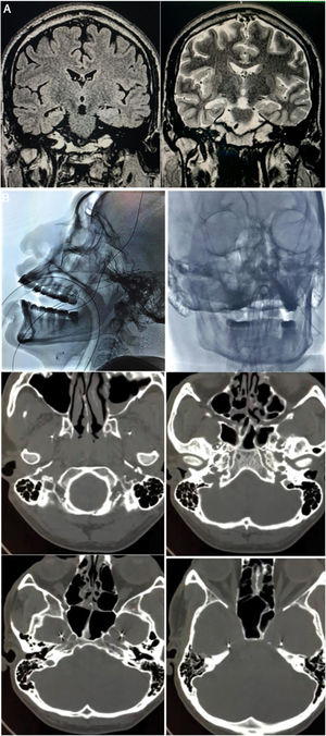 A) Resonancia magnética cerebral de 1.5T preoperatoria: a) Vista coronal T2-FLAIR con hiperintensidad en el hipocampo derecho; b) Vista coronal T2 con disminución de volumen y alteración de la arquitectura del hipocampo derecho. B) Implantación de electrodos de foramen oval (EFO): a) Proyección antero-posterior de guía fluoroscópica EFO izquierdo; b) Radiografía lateral electrodos implantados; c) Posición extracraneal infratemporal; d) Paso por el foramen oval; e y f) Localización intracraneal en aspecto mesial del lóbulo temporal (cisterna ambiens).