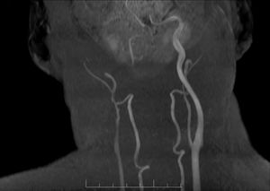 Angio-RM que muestra oclusión de la arteria carótida interna derecha hasta el origen a nivel de la bifurcación.