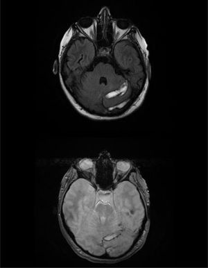 RM craneal secuencia FLAIR (A) y eco de gradiente (B) que muestran áreas de edema, isquemia y transformación hemorrágica en región parietal izquierda y cerebelo izquierdo.