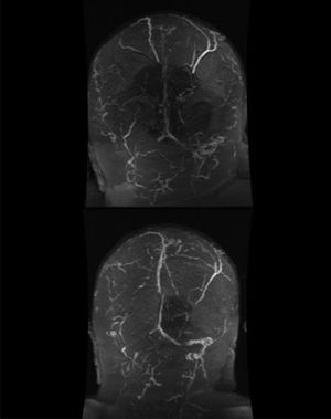 Angio-RM cerebral que muestra trombosis venosa extensa, que afecta a senos longitudinal superior, transverso y sigmoide de ambos hemisferios (A). Control en un mes (B) con recanalización parcial del seno longitudinal superior, transverso y sigmoide izquierdos tras tratamiento con dabigatrán.