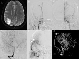 Caso demostrativo 1. EM bilateral con revascularización unilateral. A) Paciente que comienza con evento isquémico parietal derecho evidenciado por IRM. B y C) Angiografía que demuestra estenosis severa de ambas arterias carótidas internas (Suzuki estadio 5). D) Disparo a través de la arteria vertebral derecha que revela circulación colateral bilateral. E) Angiografía de control posterior a un procedimiento de revascularización de la arteria temporal superficial a la arteria cerebral media con excelente resultado (flechas). F) Angio-3D que muestra la circulación colateral (flecha) a través de la rama parietal de la arteria temporal superficial.