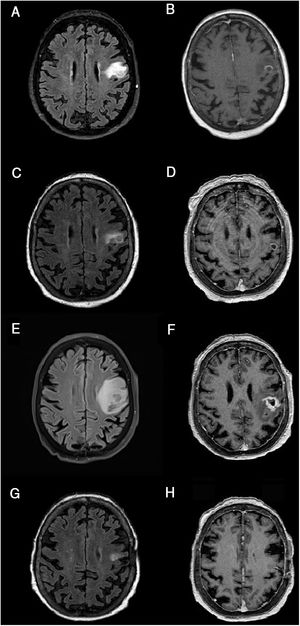 Resonancia magnética cerebral, evolución de la lesión. A-B) Resonancia magnética cerebral al ingreso. C-D) Tras 21 días de tratamiento. E-F) Tras 2 meses. G-H) Tras 3 meses desde el inicio de tratamiento. Secuencias FLAIR (A, C, E, G) y T1 tras gadolinio (B, D, F, H). Cortes axiales. Las imágenes muestran la evolución de la lesión corticosubcortical localizada en el giro precentral/opérculo frontal izquierdo, redondeada, bien definida, iso- e hiperintensa en secuencias FLAIR (A, C, E, G) e hipointensa en T1 (B, D, F, H), rodeada de edema vasogénico y captación anular de contraste (B, D, F, H). El tamaño de la lesión en el momento del ingreso era de 15 × 12mm (anteroposterior × lateromedial) (A). Tras una discreta reducción inicial del tamaño lesional a 12 × 7,5mm y una mejoría significativa del edema perilesional (C), habiendo persistido sin apenas variación la captación de contraste en anillo (D), se objetiva un marcado crecimiento de la lesión nodular hasta 16 × 16mm y un aumento importante del edema vasogénico (E) respecto al estudio previo (D). La lesión evolucionó también en morfología (más abigarrada y heterogénea) (D) y con una captación de contraste más extensa e irregular (F). Tras 3 meses desde el inicio del tratamiento con ibrutinib, se objetivó una mejoría significativa, con reducción de la lesión y mejoría del edema (G), así como una disminución de la captación de contraste, apenas perceptible (H). Se observaron cambios poscraneotomía (biopsia) (G, H).