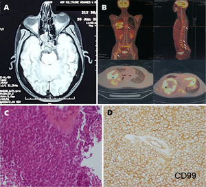 A) La resonancia magnética cerebral (sección axial T1) muestra un proceso tumoral centrado en el clivus. B) Una tomografía por emisión de positrones con 18FDG muestra la masa hipermetabólica en el pulmón derecho con unos nódulos pulmonares de la base izquierda (estrellas) y metástasis óseas difusas (flechas). C) Proliferación tumoral de células redondas. El citoplasma está mal definido y los núcleos son hipercromáticos y raramente nucleados, con presencia de mitosis anormales. D) El estudio inmunohistoquímico muestra un anticuerpo anti-CD-99 positivo.