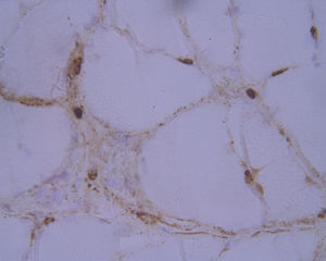 Estudio inmunohistoquímico para complejo de ataque de membrana: muestra depósito de C5b9 en capilares endomisiales.