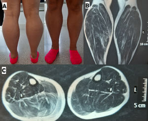 Visión posterior y anterior de las piernas de la paciente (A). Resonancia magnética de piernas T2 coronal (B) y axial (C), en la que se observa hipertrofia bilateral de tríceps sural de predominio derecho con aumento de señal en gastrocnemio derecho.