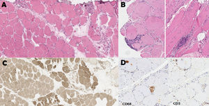 Anatomía patológica de biopsia gemelar derecha. A: Patrón de atrofia por denervación. Atrofia en grupos. HE 9x; B: Focos endomisiales de infiltrado inflamatorio HE 10x; C: Reagrupamiento de tipos ATPasa 9.4 6x; D: Macrófagos endomisiales y en el interior de fibras. Linfocitos CD3 en endomisio y rodeando fibras. IHQ CD68 y CD3 10x.