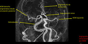 Angiografía intracraneal por RMN.