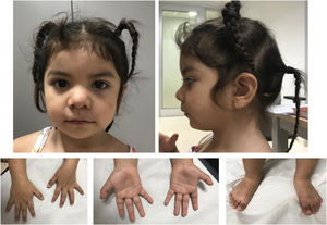 Fenotipo clínico a los 3 años de edad. Rasgos toscos, hipertelorismo leve, cejas arqueadas con discreta sinofridia, raíz nasal plana, nariz corta, narinas antevertidas. Labio superior fino con comisuras bucales descendentes. Leve retrognatia. Leve braquidactilia, polidactilia postaxial intervenida en ambos pies.