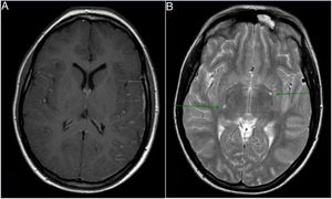 A) Corte axial T1 con contraste que objetiva realce leptomeníngeo. B) Corte axial T2 espacios Virchow-Robin dilatados (flechas).